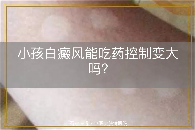 小孩白癜风能吃药控制变大吗？
