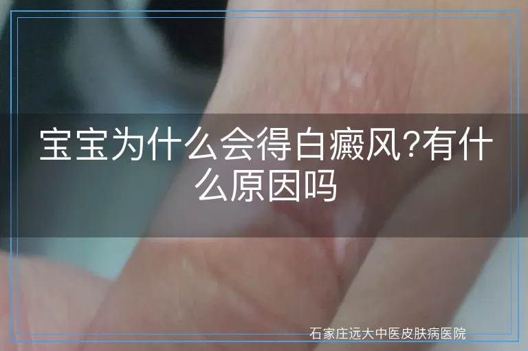 宝宝为什么会得白癜风?有什么原因吗