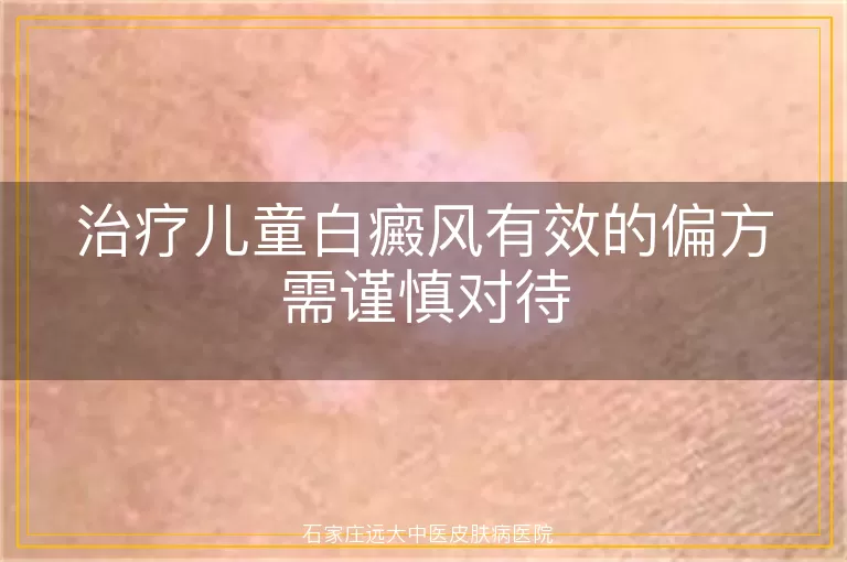治疗儿童白癜风有效的偏方需谨慎对待
