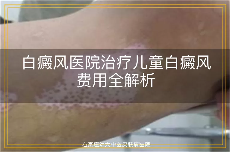 白癜风医院治疗儿童白癜风费用全解析