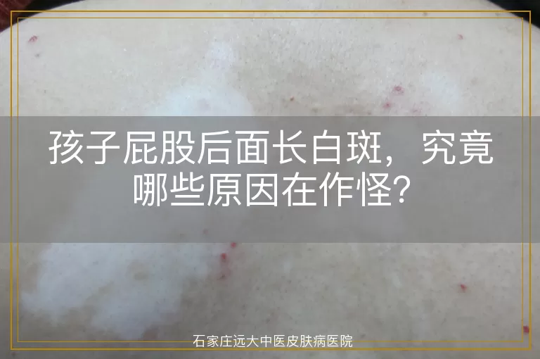 孩子屁股后面长白斑，究竟哪些原因在作怪？