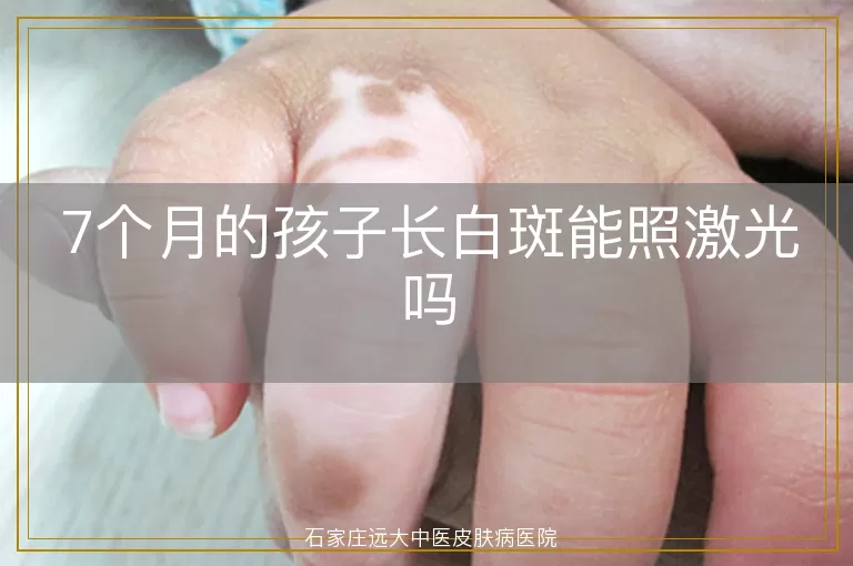 7个月的孩子长白斑能照激光吗