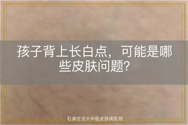 孩子背上长白点，可能是哪些皮肤问题？