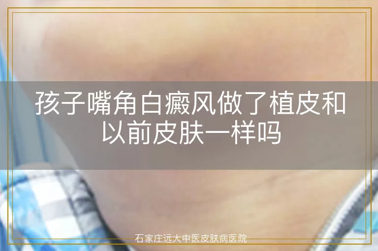 孩子嘴角白癜风做了植皮和以前皮肤一样吗