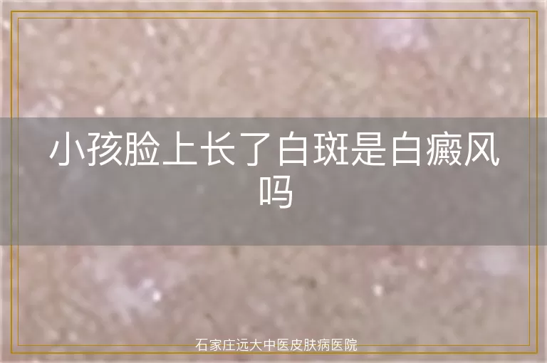 小孩脸上长了白斑是白癜风吗