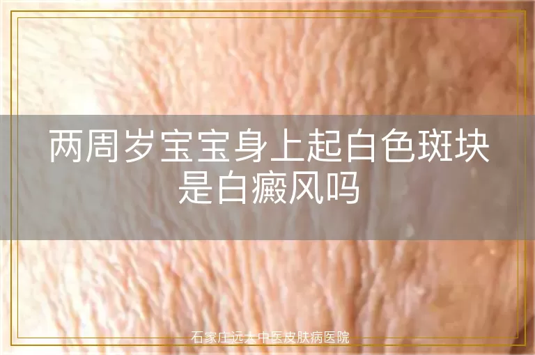 两周岁宝宝身上起白色斑块是白癜风吗