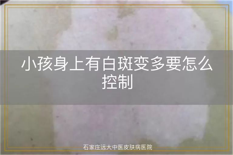 小孩身上有白斑变多要怎么控制