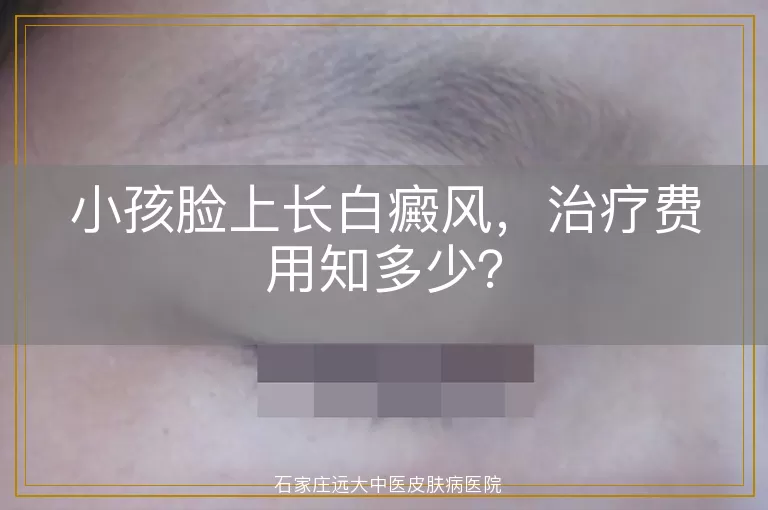小孩脸上长白癜风，治疗费用知多少？