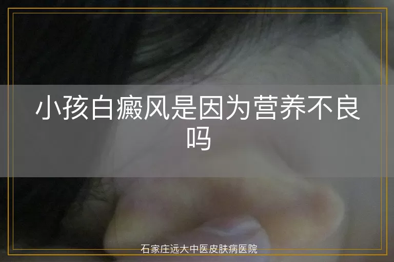 小孩白癜风是因为营养不良吗