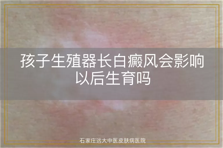 孩子生殖器长白癜风会影响以后生育吗