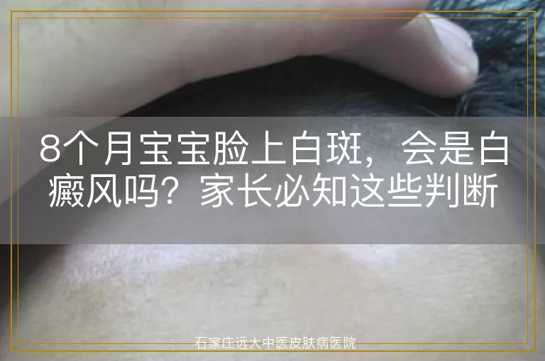 8个月宝宝脸上白斑，会是白癜风吗？家长必知这些判断方法