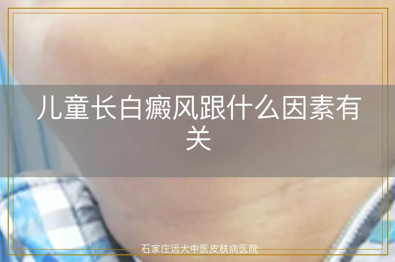 儿童长白癜风跟什么因素有关