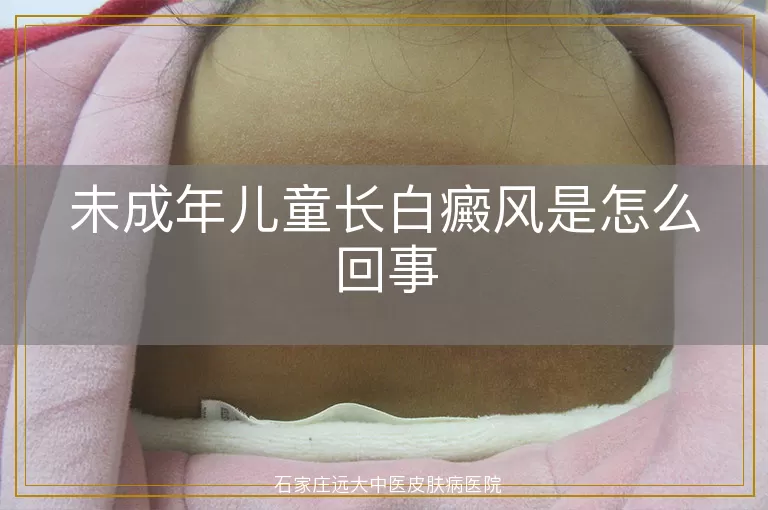 未成年儿童长白癜风是怎么回事