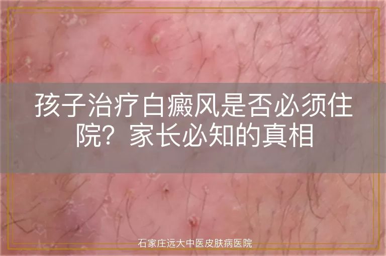 孩子治疗白癜风是否必须住院？家长必知的真相