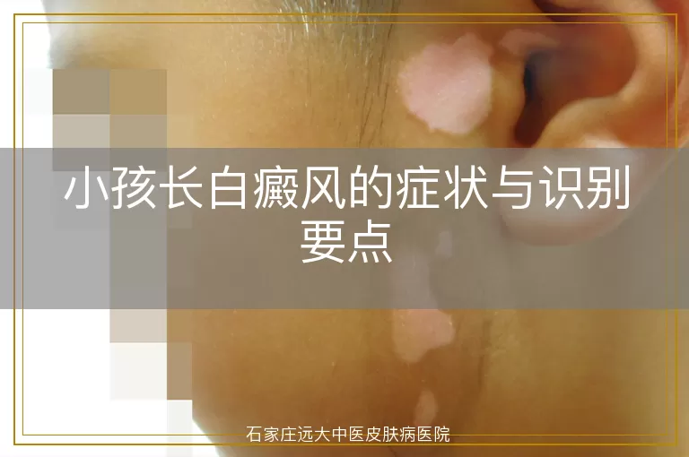小孩长白癜风的症状与识别要点