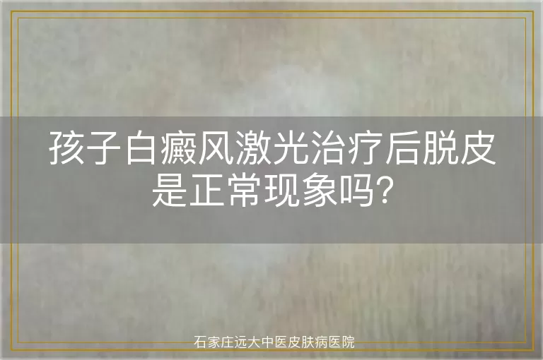 孩子白癜风激光治疗后脱皮是正常现象吗?