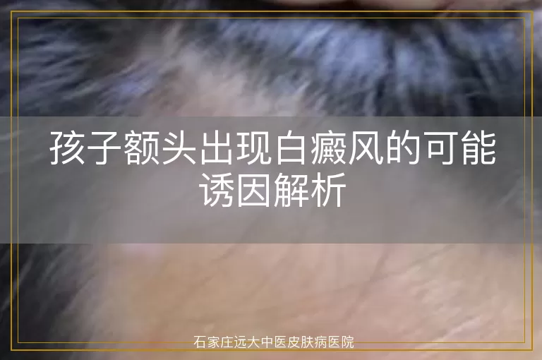 孩子额头出现白癜风的可能诱因解析