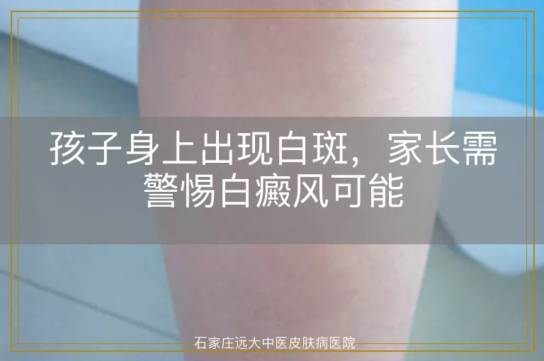 孩子身上出现白斑，家长需警惕白癜风可能
