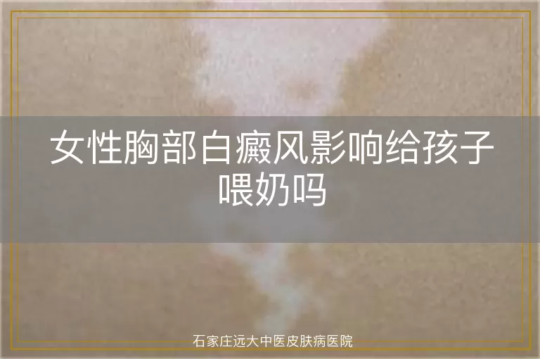 女性胸部白癜风影响给孩子喂奶吗