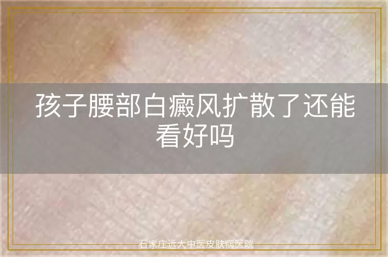 孩子腰部白癜风扩散了还能看好吗