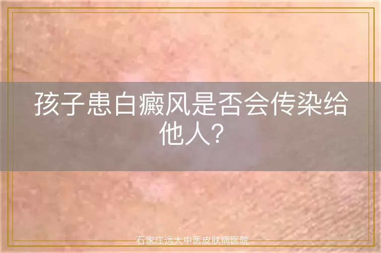 孩子患白癜风是否会传染给他人？