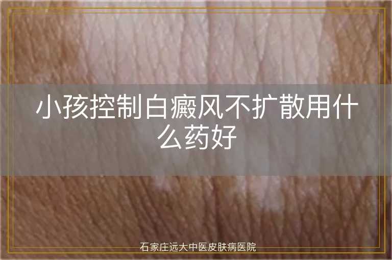 小孩控制白癜风不扩散用什么药好