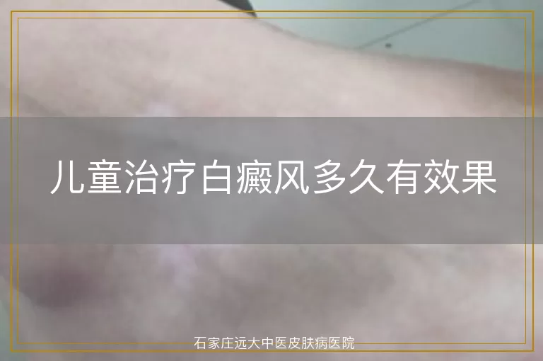 儿童治疗白癜风多久有效果