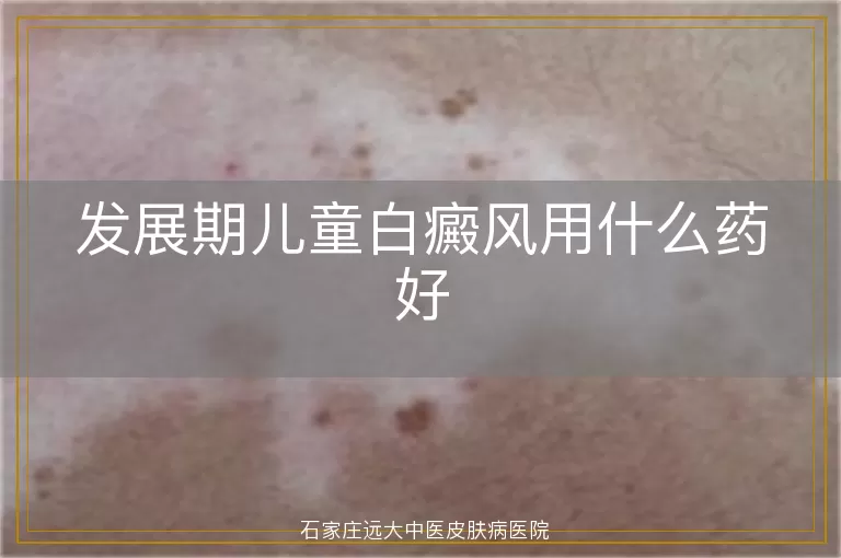 发展期儿童白癜风用什么药好