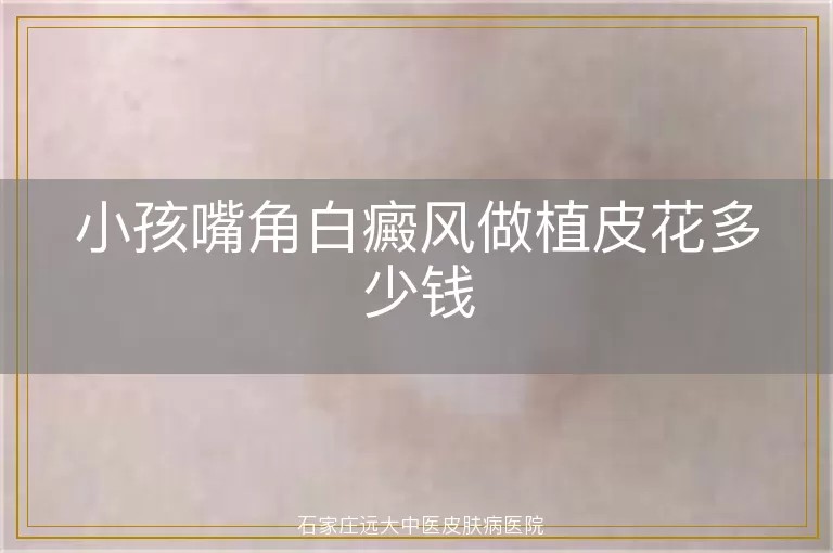 小孩嘴角白癜风做植皮花多少钱