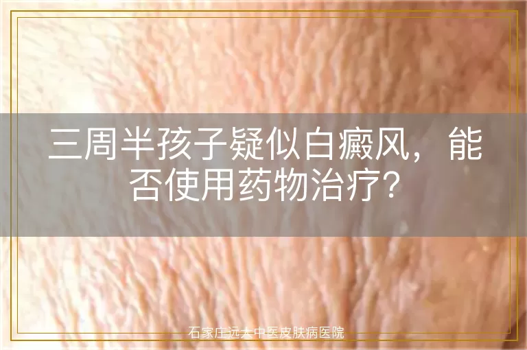 三周半孩子疑似白癜风，能否使用药物治疗？