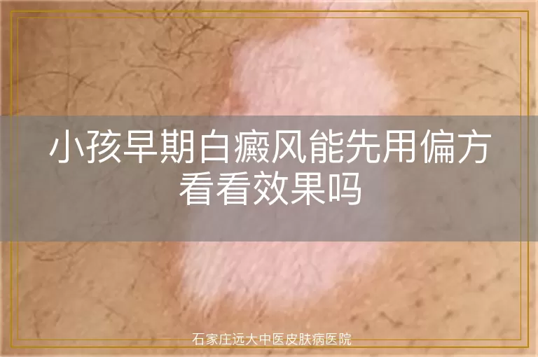 小孩早期白癜风能先用偏方看看效果吗