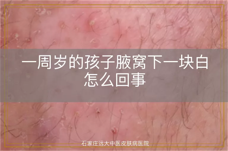 一周岁的孩子腋窝下一块白怎么回事