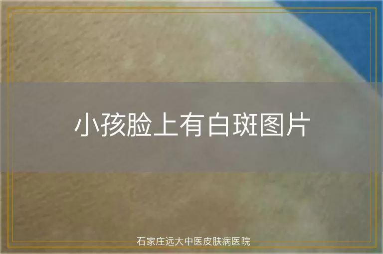 小孩脸上有白斑图片