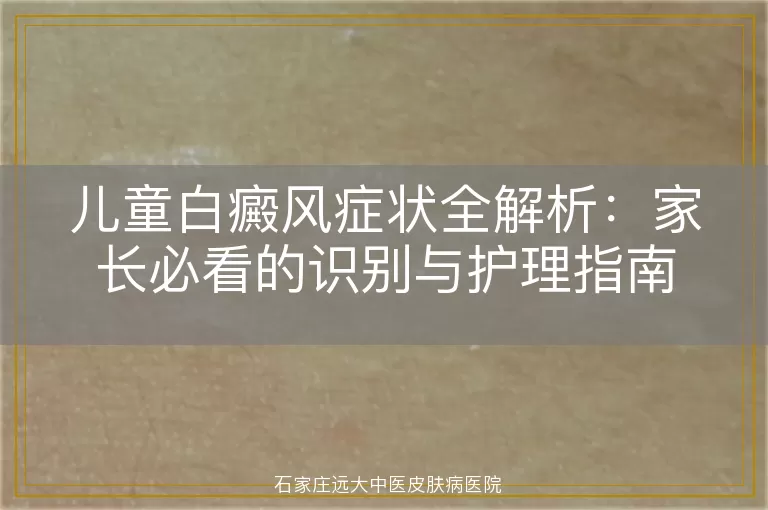 儿童白癜风症状全解析：家长必看的识别与护理指南