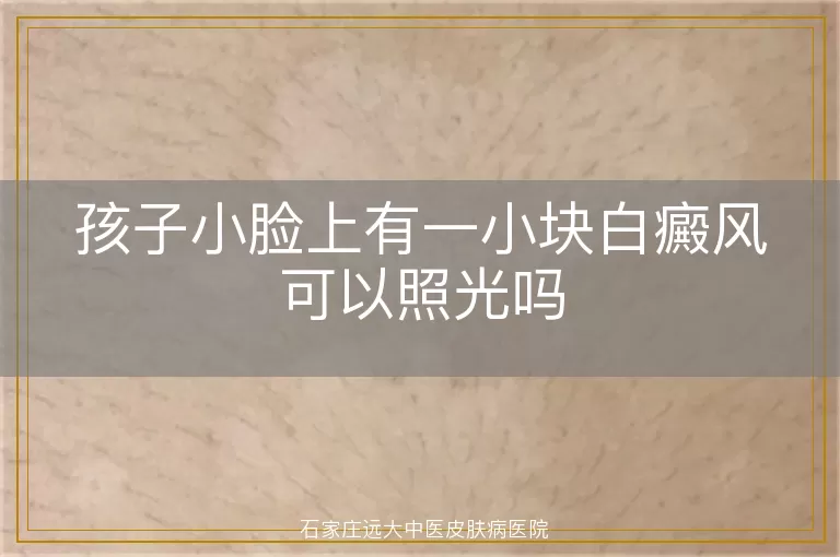 孩子小脸上有一小块白癜风可以照光吗