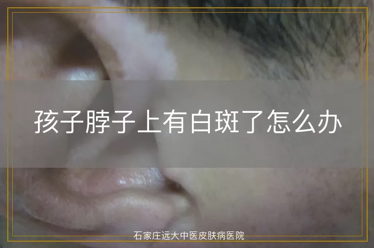 孩子脖子上有白斑了怎么办