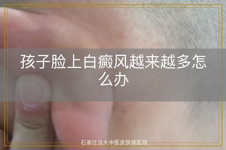 孩子脸上白癜风越来越多怎么办