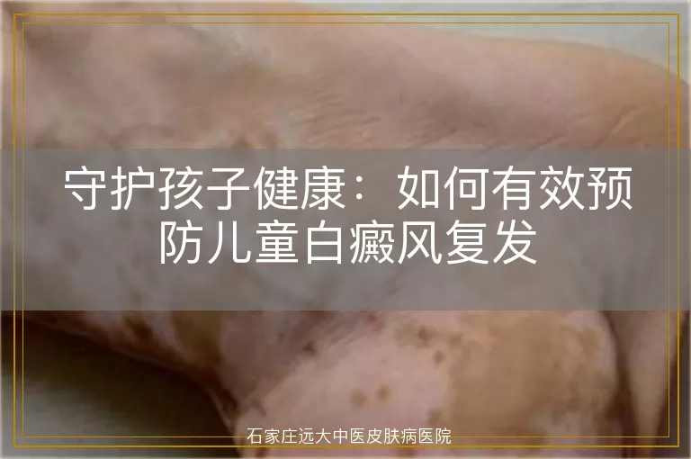 守护孩子健康：如何有效预防儿童白癜风复发