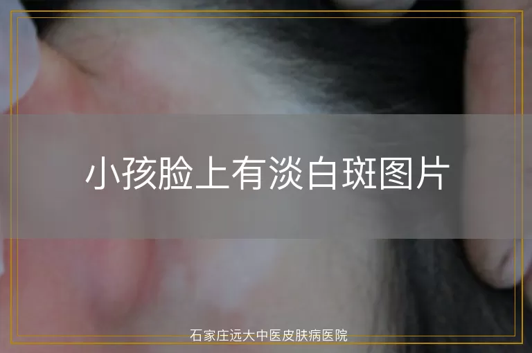 小孩脸上有淡白斑图片