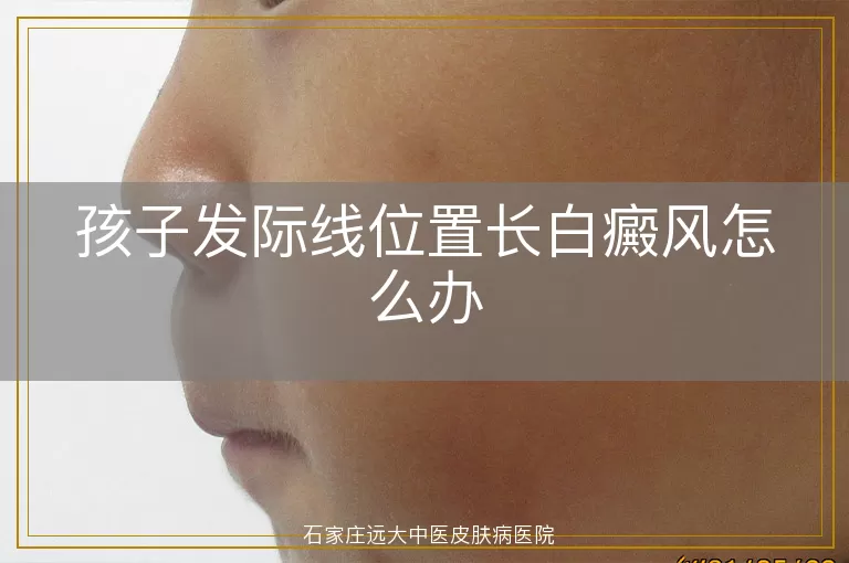 孩子发际线位置长白癜风怎么办