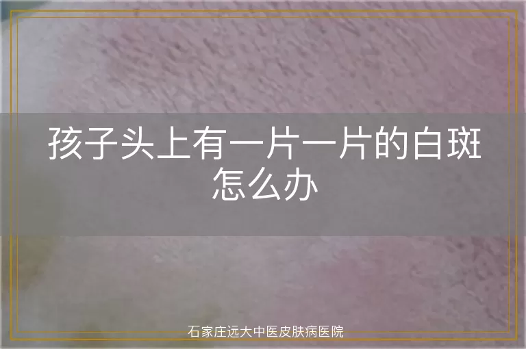 孩子头上有一片一片的白斑怎么办