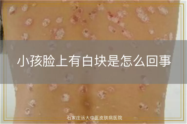 小孩脸上有白块是怎么回事