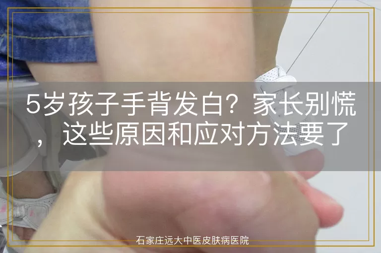 5岁孩子手背发白?家长别慌,这些原因和应对方法要了解