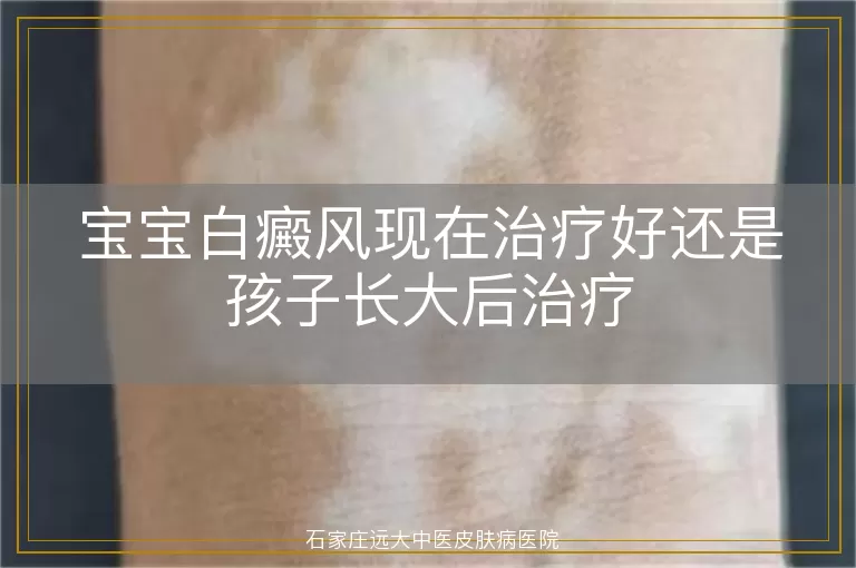 宝宝白癜风现在治疗好还是孩子长大后治疗