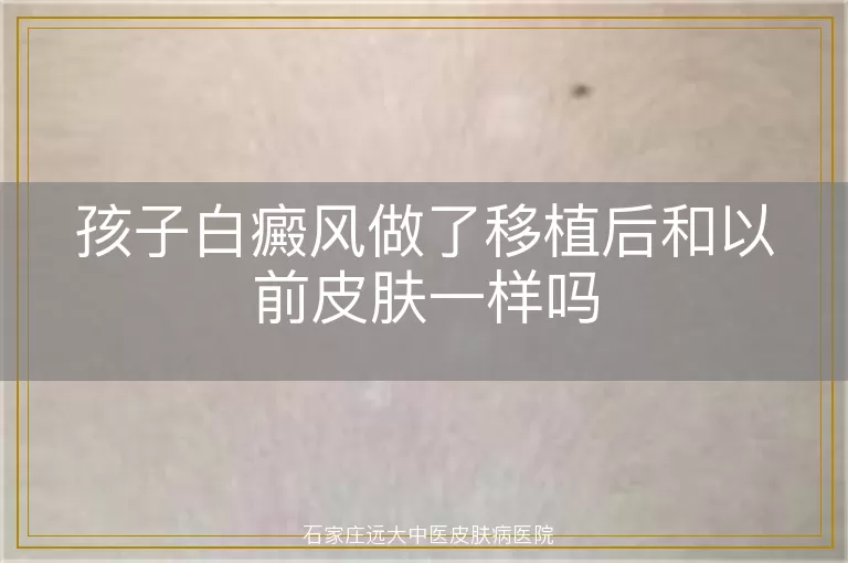 孩子白癜风做了移植后和以前皮肤一样吗
