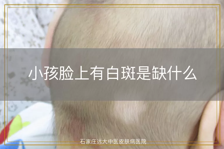 小孩脸上有白斑是缺什么