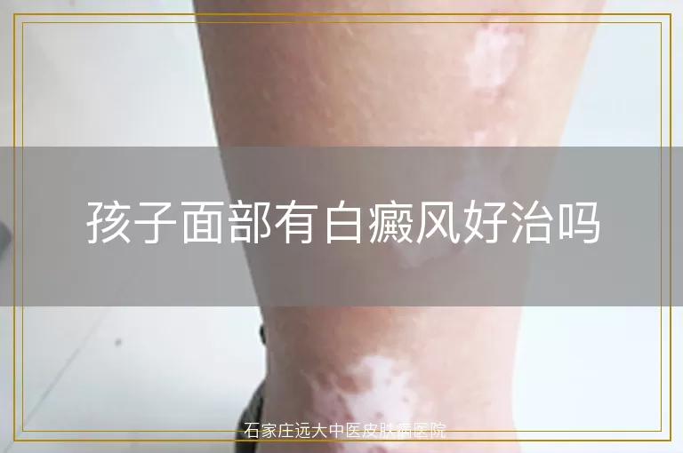 孩子面部有白癜风好治吗