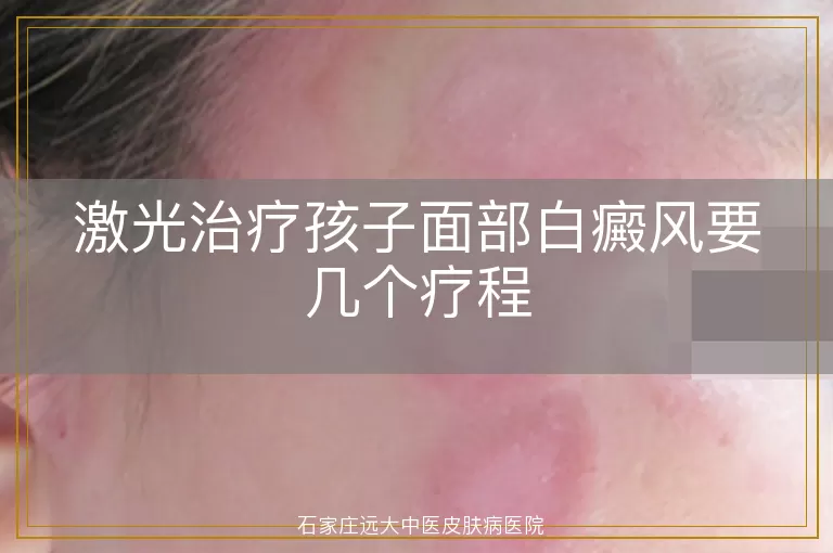 激光治疗孩子面部白癜风要几个疗程