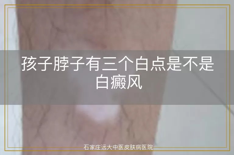 孩子脖子有三个白点是不是白癜风
