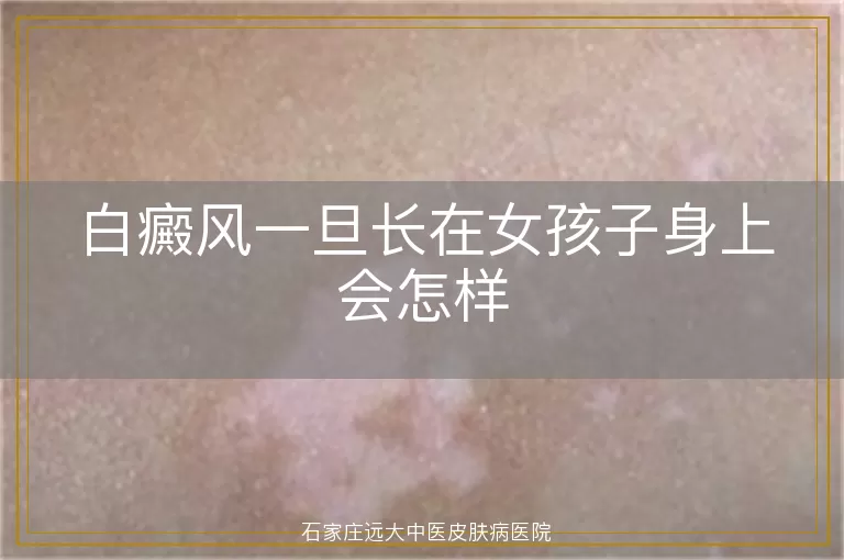 白癜风一旦长在女孩子身上会怎样
